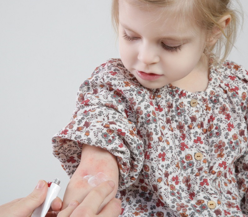 Urticaria crónica espontánea: causas, diagnóstico y tratamiento