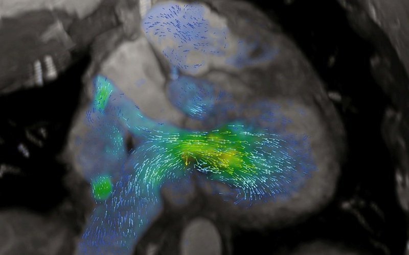 Secuencia 4D flow de una transposición de grandes arterias