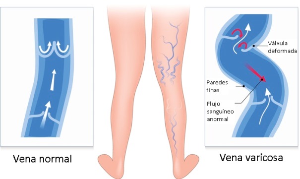 Vena normal y vena con varices