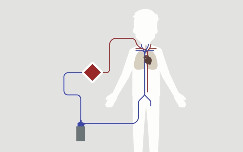 Circuito del equipo ECMO